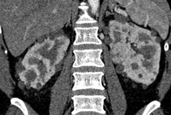 Renal Cell Carcinoma - CTisus CT Scan