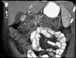 Pancreatic Cysts - CTisus CT Scan