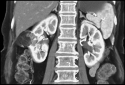 Renal Angiomyolipoma (AML) - CTisus CT Scan