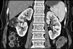 Renal Angiomyolipoma (AML) - CTisus CT Scan