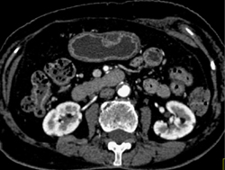 Renal Angiomyolipoma (AML) - CTisus CT Scan