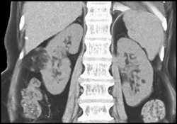 Renal Angiomyolipoma (AML) - CTisus CT Scan