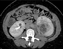 Renal Abscess With Renal Vein Thrombosis - CTisus CT Scan