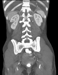 Renal Infarct - CTisus CT Scan