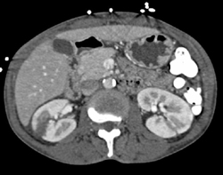 Renal Infarct - CTisus CT Scan