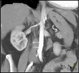 Renal Artery Stenosis - CTisus CT Scan