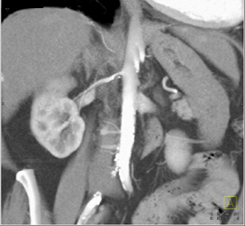 Renal Artery Stenosis - CTisus CT Scan