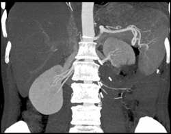 Prior Partial Left Nephrectomy - CTisus CT Scan