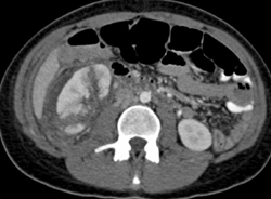 Renal Laceration - CTisus CT Scan