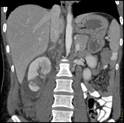 Renal Laceration - CTisus CT Scan