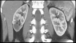 Left Renal Infection - CTisus CT Scan