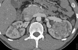 Multiple Angiomyolipomas (AMLs) - CTisus CT Scan