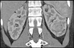 Multiple Angiomyolipomas - CTisus CT Scan