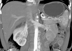 Post Partial Nephrectomy - CTisus CT Scan