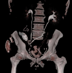 Ileal Bladder - CTisus CT Scan