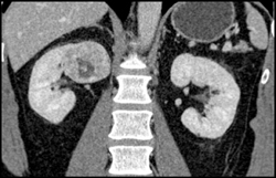 Renal Cell Carcinoma With VRT-MIP-MPR - CTisus CT Scan