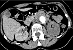 Renal Infarction S/P Aneurysm Repair - CTisus CT Scan