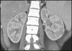 Renal Abscess on Left - CTisus CT Scan