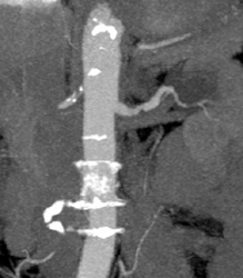 Renal Artery Stenosis - CTisus CT Scan