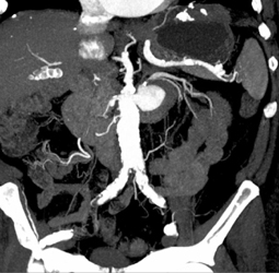 Large Left Renal Artery Aneurysm - CTisus CT Scan