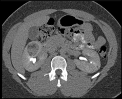 Renal Angiomyolipoma (AML) - CTisus CT Scan