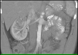 Renal Angiomyolipoma (AML) - CTisus CT Scan