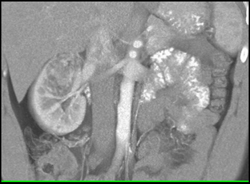 Renal Angiomyolipoma (AML) - CTisus CT Scan