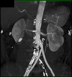 Renal Artery Stents That Are Patent Using MPR and 3D Imaging - CTisus CT Scan