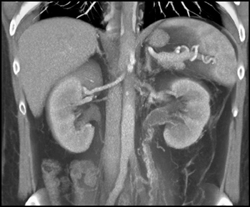 Chronic Left Renal Vein Thrombosis With Perirenal Cobwebs - CTisus CT Scan