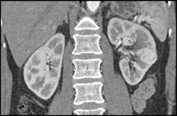 Vascular Renal Cell Carcinoma That Is Hard to See on Arterial Phase Imaging - CTisus CT Scan