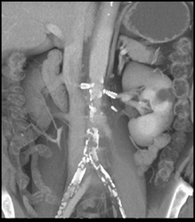 Patent Renal Artery Stents - CTisus CT Scan