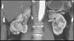 Hypervascular Renal Cell Carcinoma - CTisus CT Scan