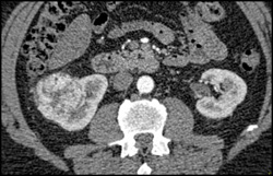 Hypervascular Renal Cell Carcinoma - CTisus CT Scan