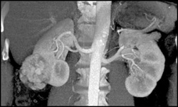 Hypervascular Renal Cell Carcinoma - CTisus CT Scan