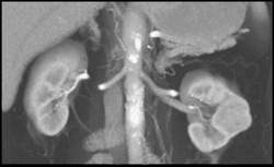 Left Renal Cell Carcinoma - CTisus CT Scan