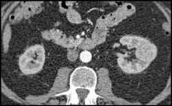 Left Renal Cell Carcinoma - CTisus CT Scan