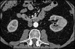 Left Renal Cell Carcinoma - CTisus CT Scan