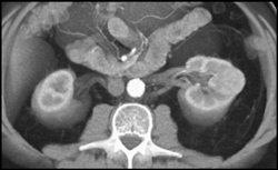 Left Renal Cell Carcinoma - CTisus CT Scan