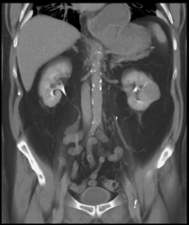 Left Renal Cell Carcinoma - CTisus CT Scan