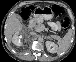 Hemorrhage S/P Partial Nephrectomy - CTisus CT Scan