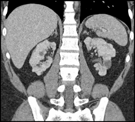 Chronic Pyelonephritis With Scarring - CTisus CT Scan