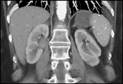 Transitional Cell Carcinoma in Right Renal Pelvis - CTisus CT Scan