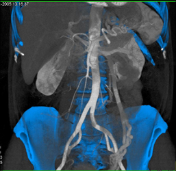 Prominent Left Gonadal Vein - CTisus CT Scan