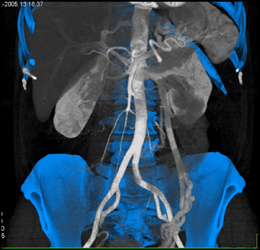 Prominent Left Gonadal Vein - CTisus CT Scan