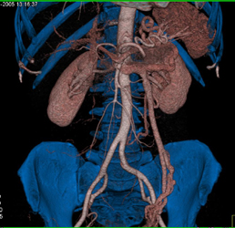 Prominent Left Gonadal Vein - CTisus CT Scan