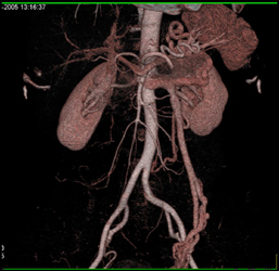 Prominent Left Gonadal Vein - CTisus CT Scan