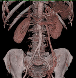 Prominent Left Gonadal Vein - CTisus CT Scan