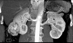 Renal Cell Carcinoma - CTisus CT Scan