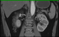 Renal Artery Aneurysm - CTisus CT Scan