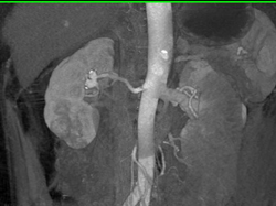 Renal Artery Aneurysm - CTisus CT Scan